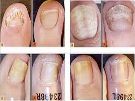 Canker / Nail Infaction Treatment Pic