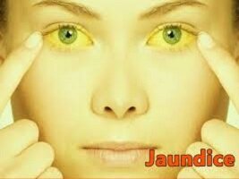 Jaundice Pic